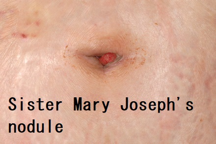 Sister Mary Joseph's nodule